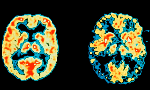 PET-skanning af en normal hjerne, til venstre, og en hjerne fra en Alzheimer patient.